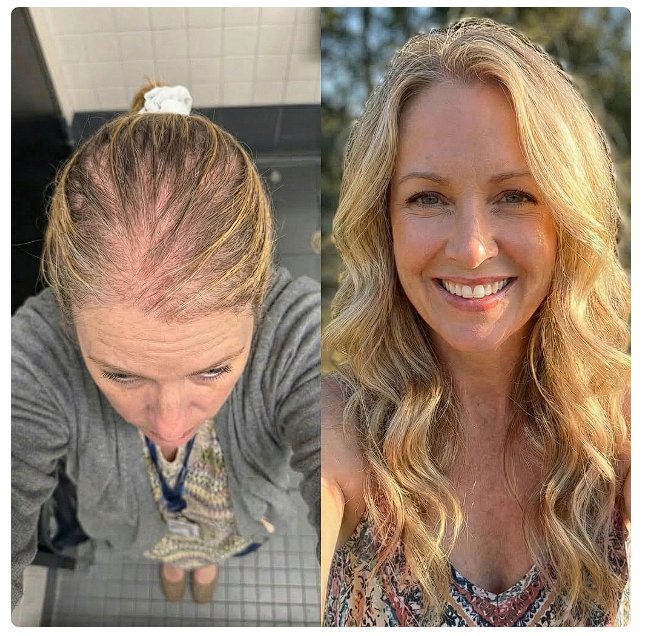 Before and after crown filling in